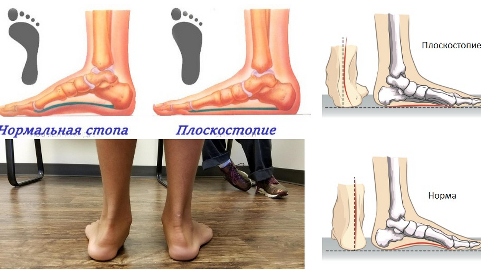 Нормальная стопа человека фото