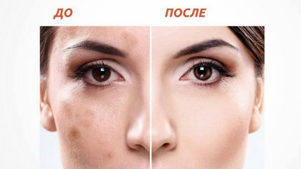 Самый популярный крем от пигментации - EXPIGMENT | Красота | WB Guru