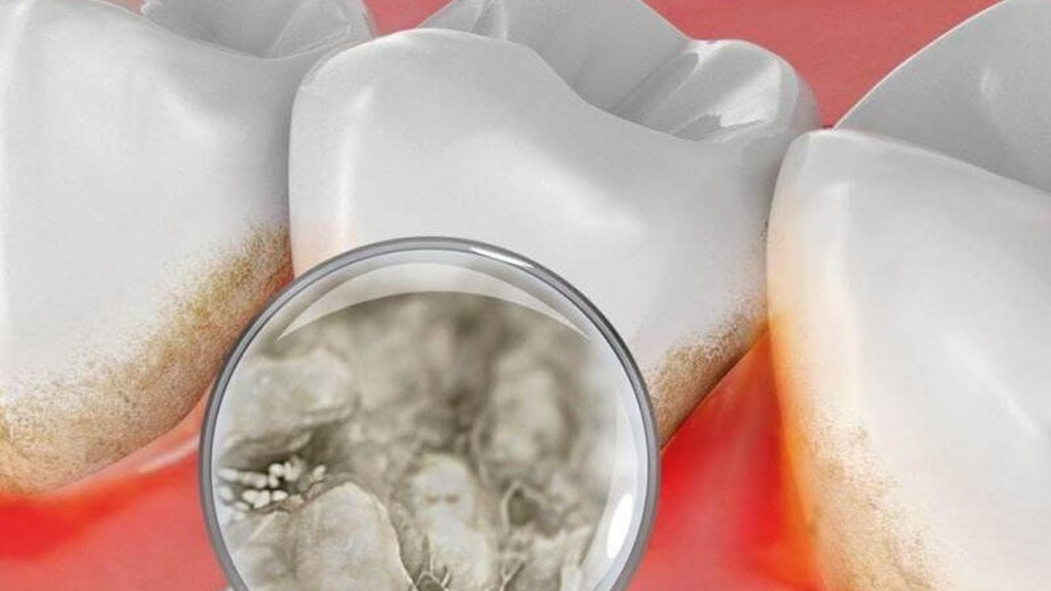 Возможно ли удаление зубного камня в домашних условиях – способы