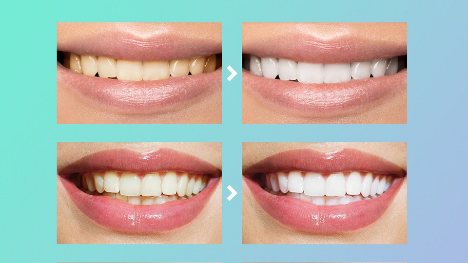 Какие продукты помогают отбелить зубы?