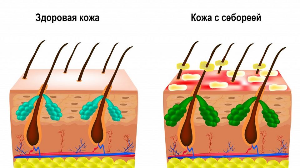 Какой мужской шампунь лучше всего подходит для жирных волос? | Красота ...