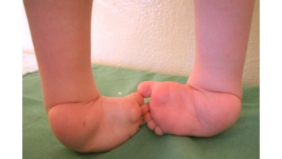 Симптомы вальгусной деформации стопы у детей